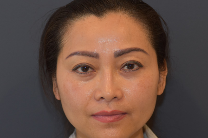 Brow Lift - Penn Medicine Cosmetic Services